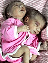 印度女子产下双头奇迹宝宝